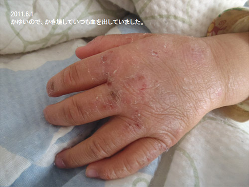 赤ちゃんのアトピー性皮膚炎の改善例 Lps原料の自然免疫応用技研 株 Lps原料 受託解析 研究開発