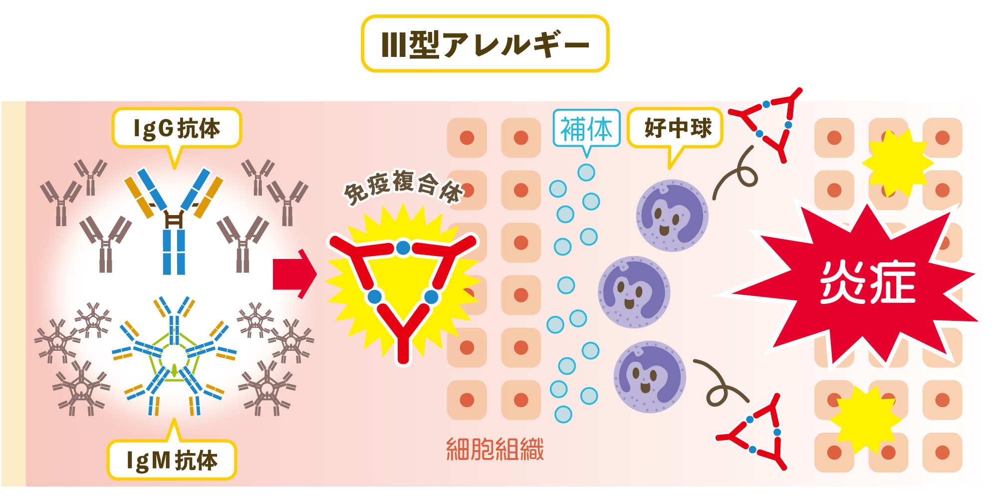 アレルギーは免疫の過剰反応によって起こる その種類やメカニズムとは やさしいlps